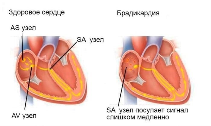 Брадикардия, вызванная снижением пульса в результате воздействия синусового узла.